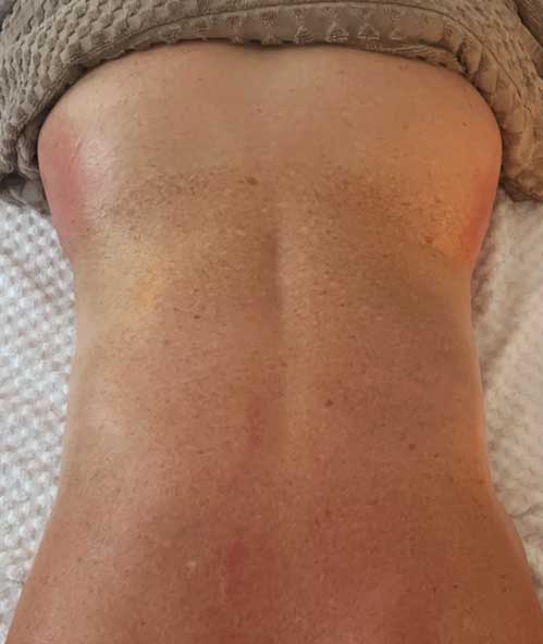 Body Contour After