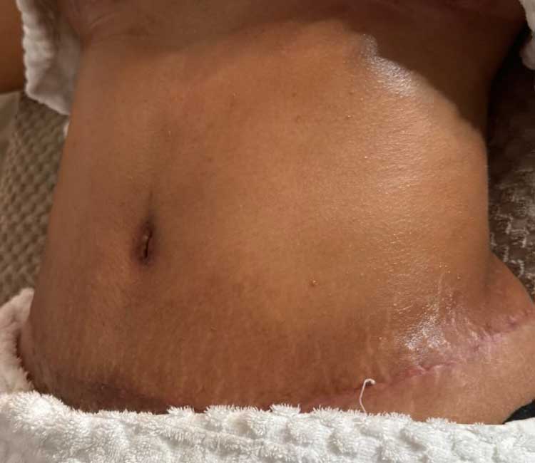 Scar and Fibrotic Treatment Before