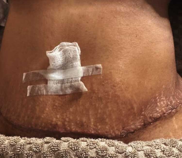 Scar and Fibrotic Treatment After